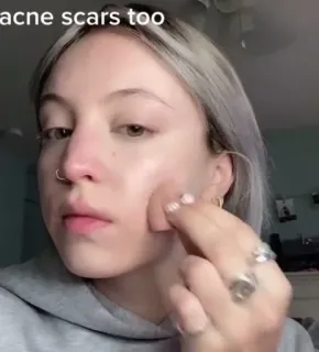 💜 acne scars too Akne, Narben, Schönheit, Haut, Frau, Gesicht telegram sticker